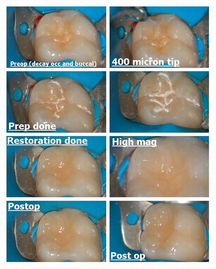 Resize of Microdental Fissure Sealant type prep.jpg